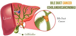 BileDuctCancer