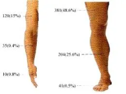 ExtremitylimbSarcoma ExtremitylimbSarcoma