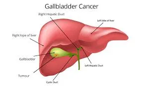 GallBladderCancer GallBladderCancer