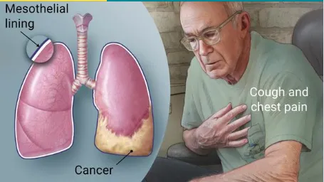 Mesothelioma 2 Mesothelioma 2