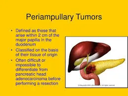 PeriampullaryCancer PeriampullaryCancer