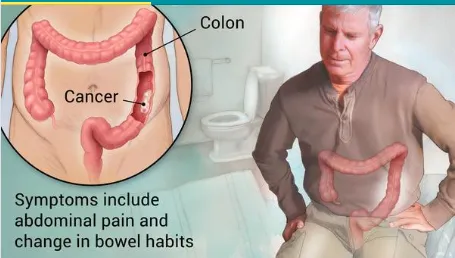 RectalCancer RectalCancer