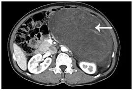 RetroperitonealSarcoma RetroperitonealSarcoma