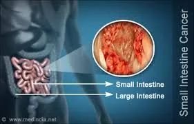 SmallIntestinalCancer SmallIntestinalCancer