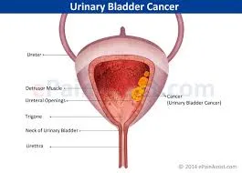 UrinaryBladderCancer