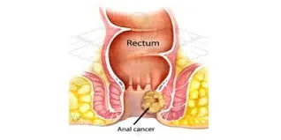 analcanalcancer analcanalcancer