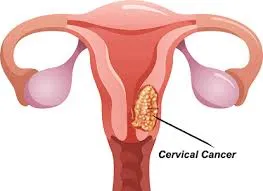cervixcancer cervixcancer