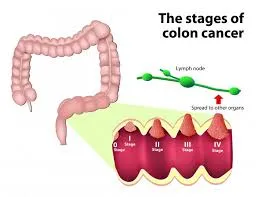 coloncancer