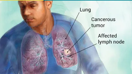 lungcancer lungcancer