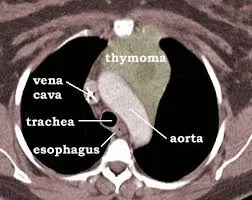 thymoma