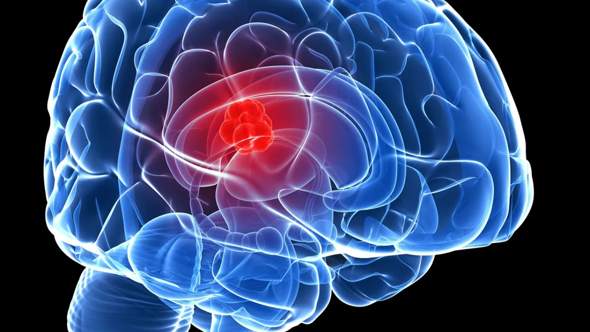 1BRAIN TUMORS1