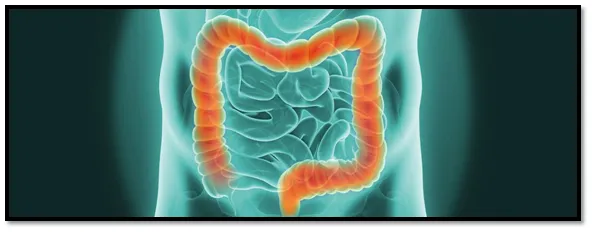 Colorectal cancer Colorectal cancer