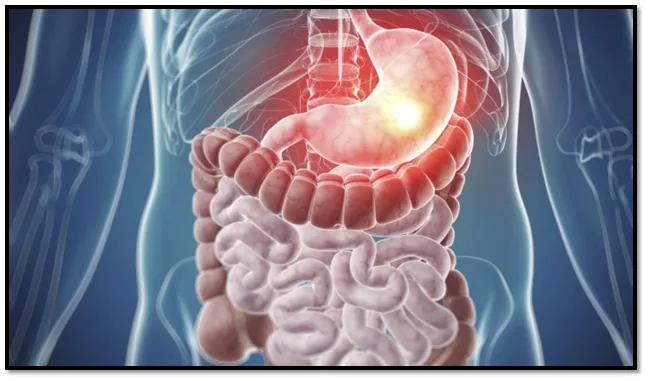 Gastrointestinal Cancer Gastrointestinal Cancer