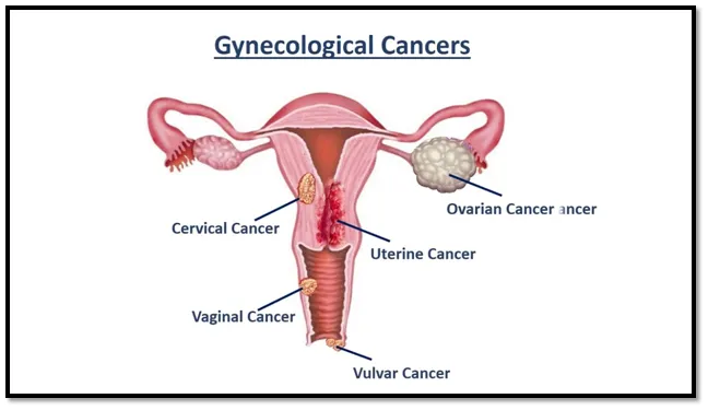 Gynecologic Cancer1 Gynecologic Cancer1