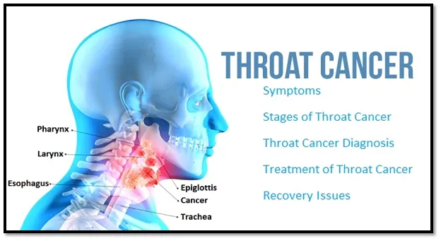 throat cancer