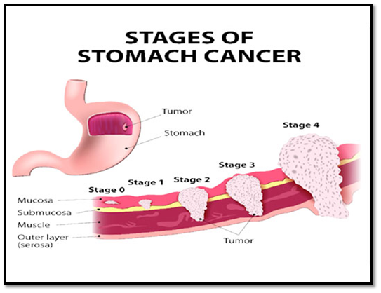 Stomach Cancer - Prolife Cancer Centre