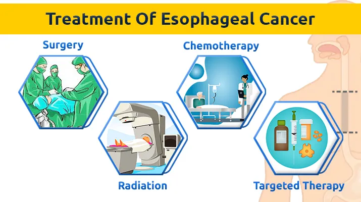 Treatment Of Esophageal Cancer 2