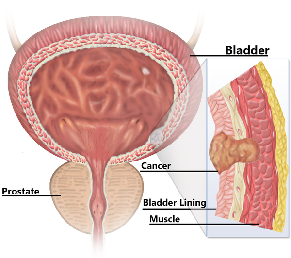 Bladder Cancer treatment in Pune