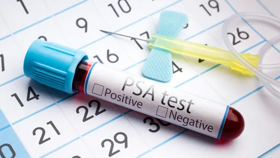 Sharp Decline In Prostate Cancer Screening Sharp Decline In Prostate Cancer Screening