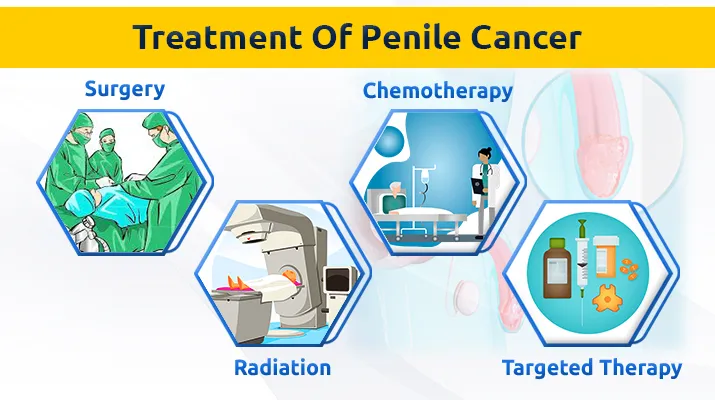 Treatment Of penile Cancer Treatment Of penile Cancer