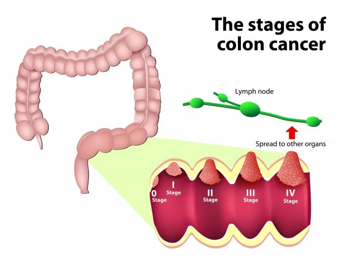 intestinal cancer