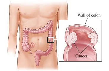 colon cancer 1