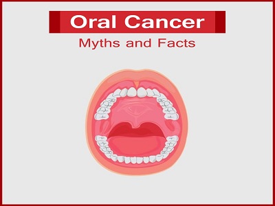 Oral Cancer: Myths and Facts