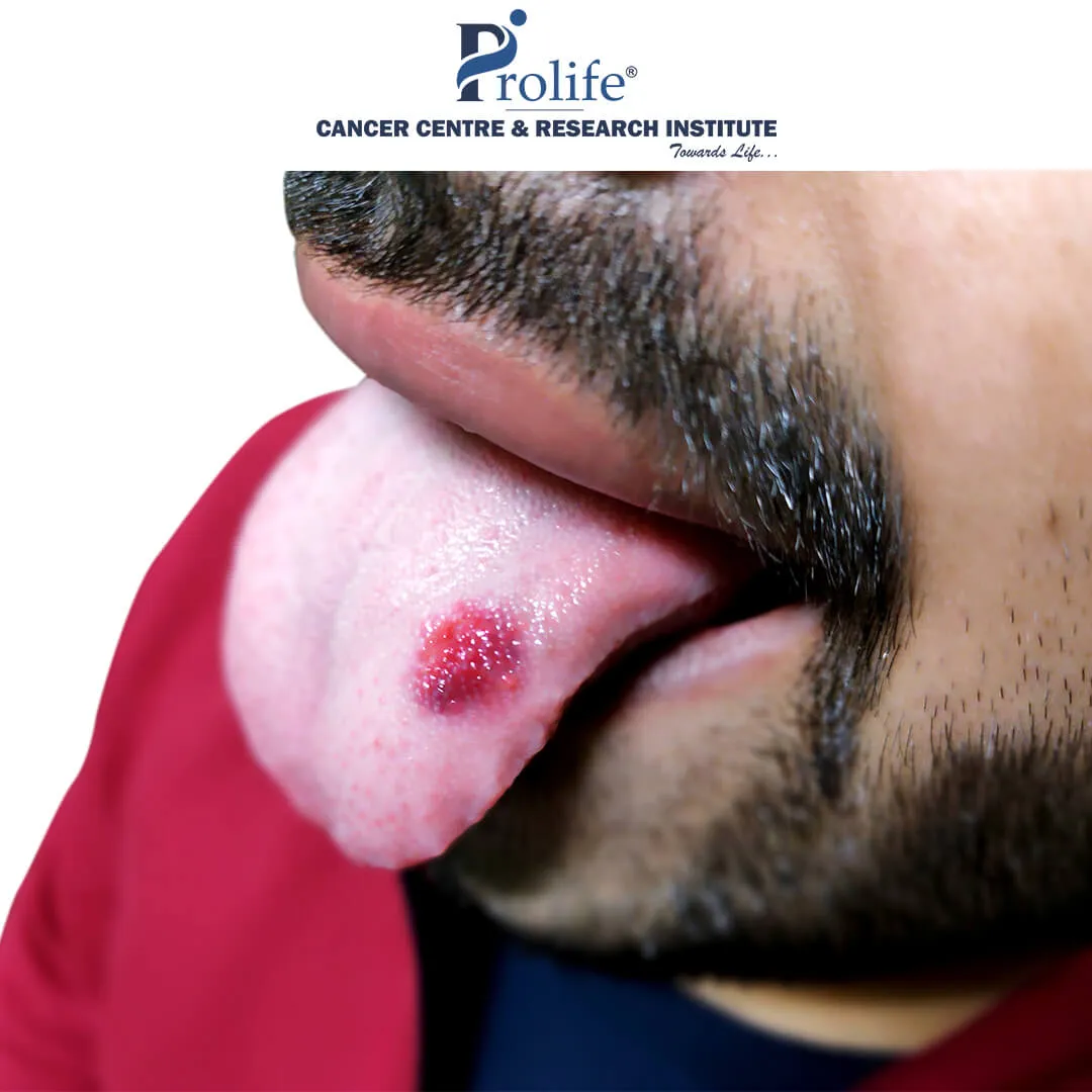 Oral Cancer Treatment in Pune
