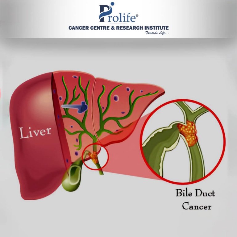 What Are Signs & Symptoms Of Bile Duct Cancer - Prolife Cancer Centre