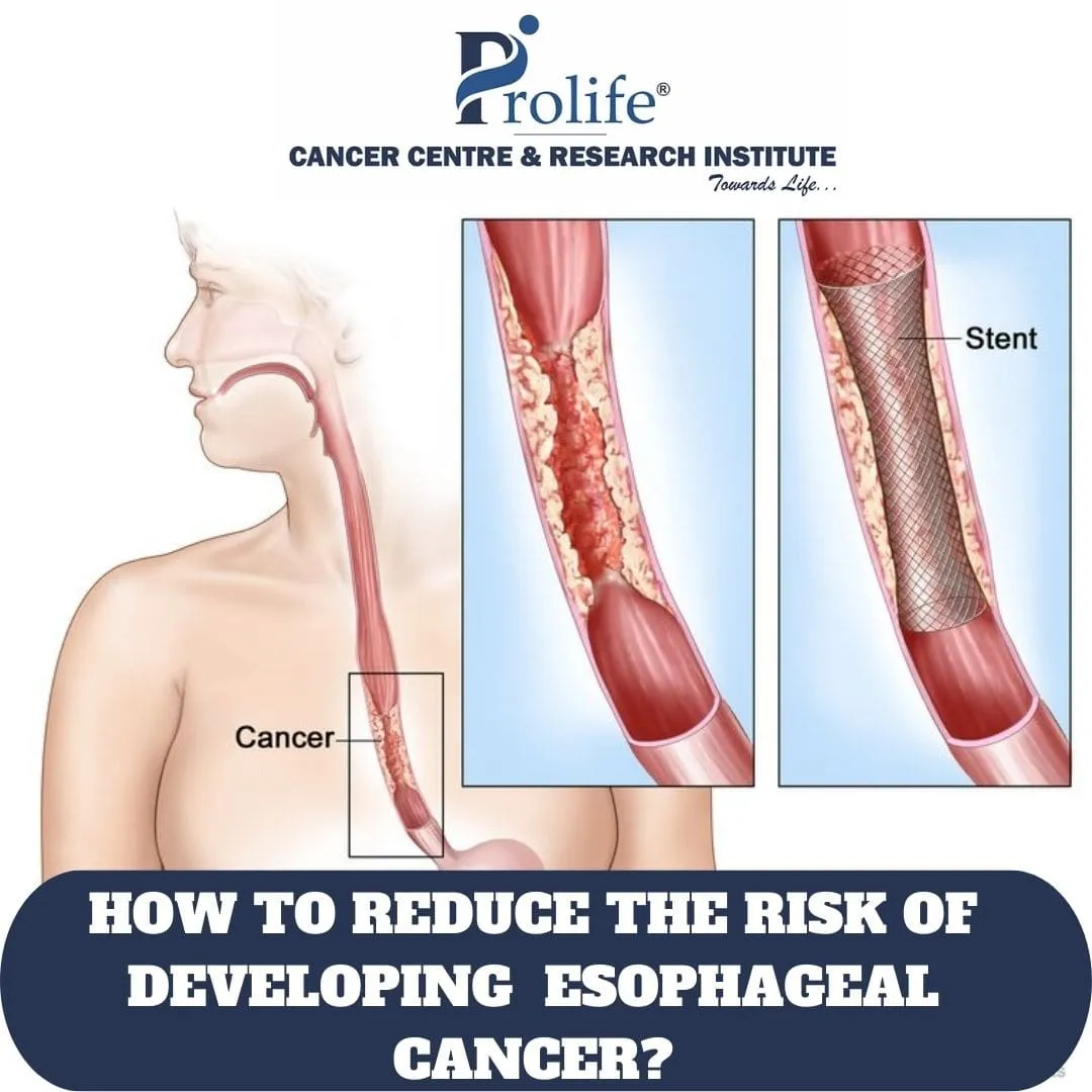 Esophageal Cancer Treatment inPune min