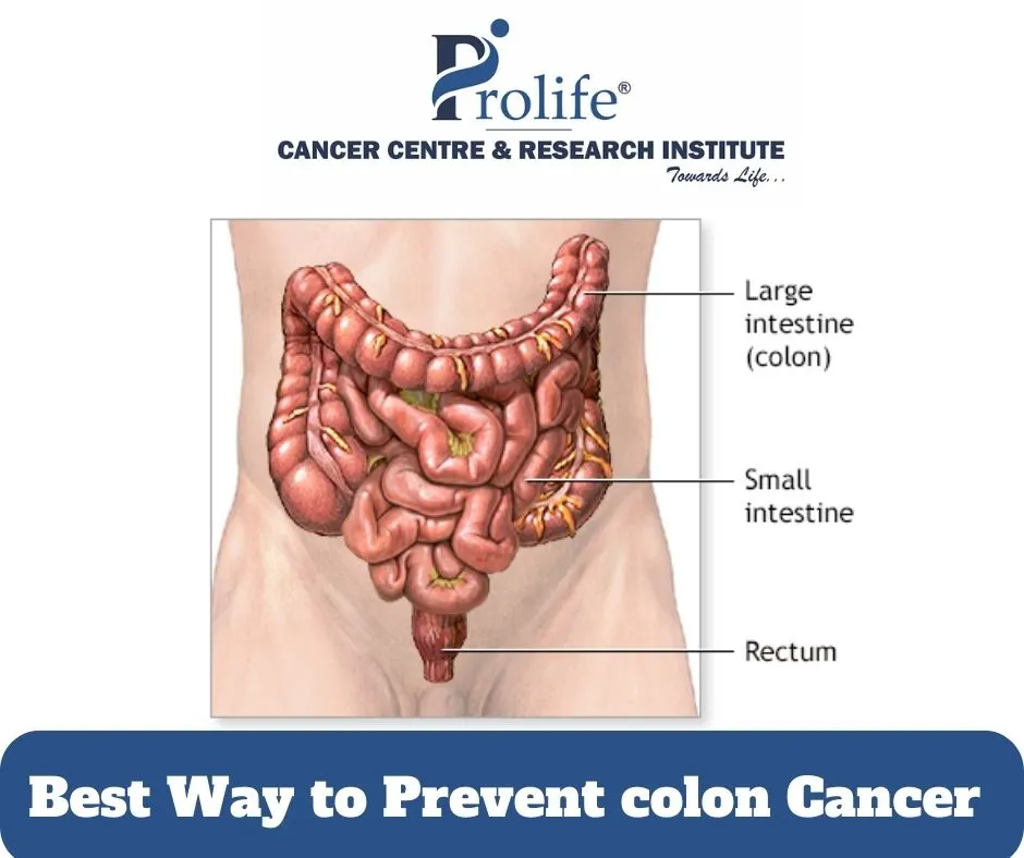 Best Way to Prevent Colon Cancer