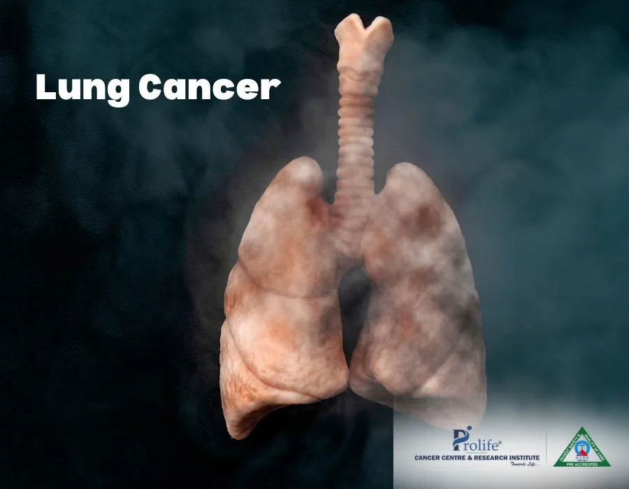 Lung Cancer 1