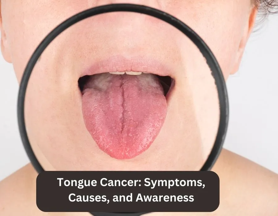 Tongue Cancer Symptoms Causes and Awareness 1