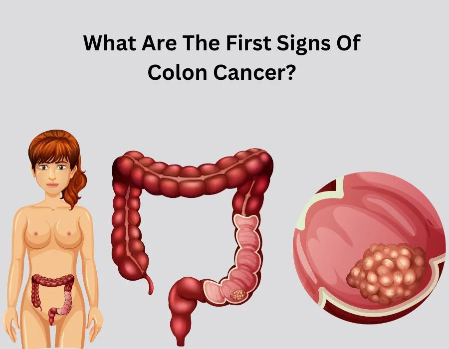 What Are The First Signs Of Colon Cancer