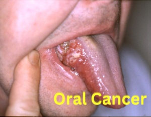 Oral Cancer Treatment in Pune | Oral Cancer Specialist In Pune | Dr. Sumit Shah