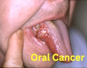 Oral Cancer