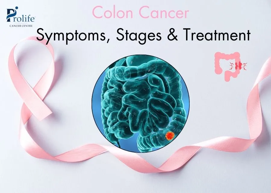 Colon Cancer Symptoms Stages Treatment