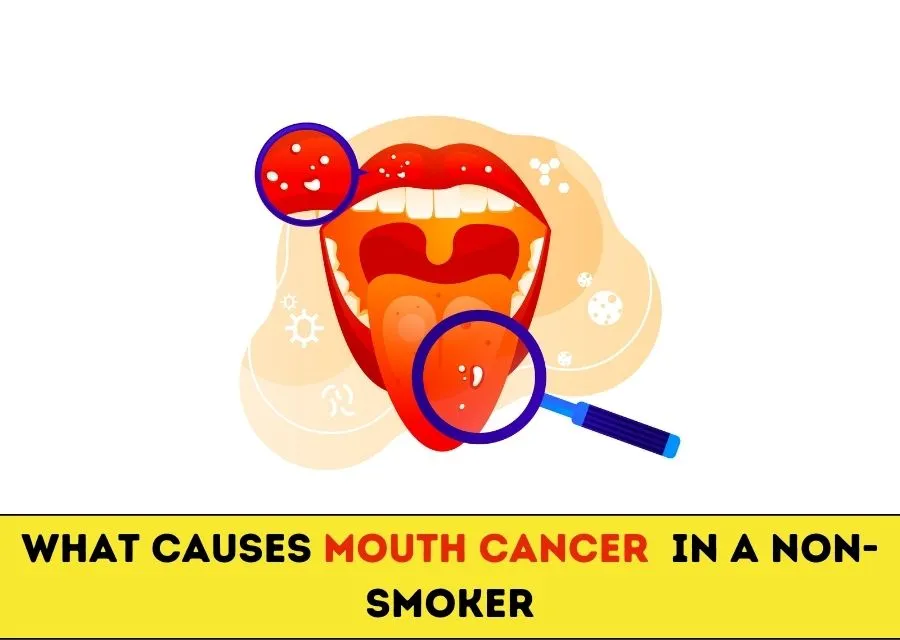 What Causes Mouth Cancer In A Non Smoker