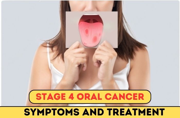 Stage 4 Oral Cancer: Symptoms And Treatment