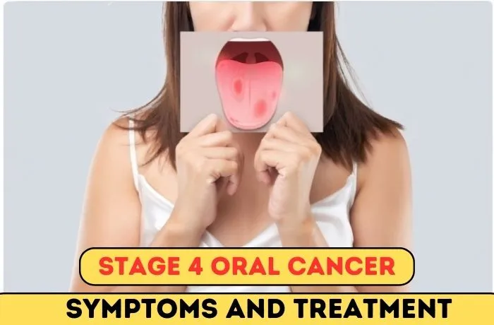 Stage 4 Oral Cancer Symptoms And Treatment
