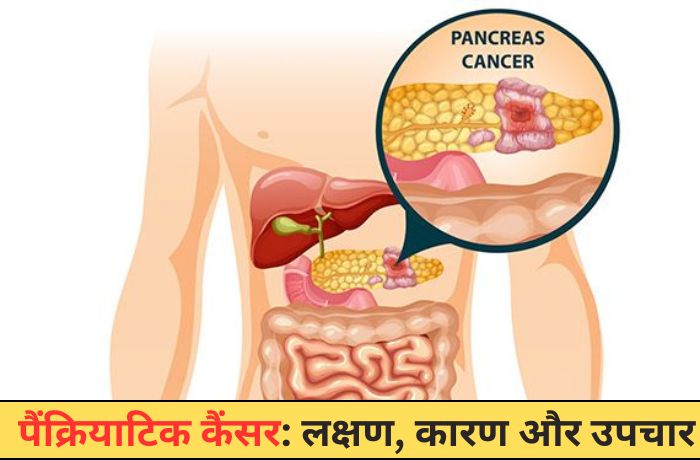 अग्नाशय (पैंक्रियाटिक) कैंसर लक्षण, कारण और उपचार