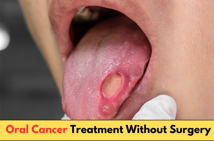 Oral Cancer Treatment Without Surgery