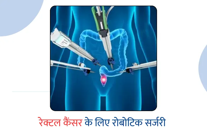 के लिए रोबोटिक सर्जरी – Robotic Surgery for Rectal Cancer