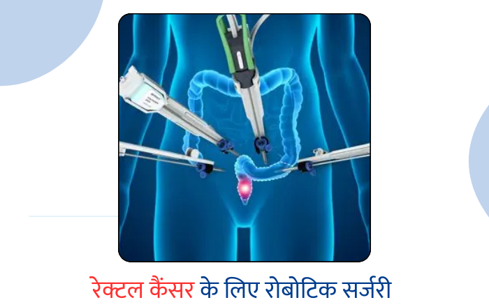 रेक्टल कॅन्सर के लिए रोबोटिक सर्जरी – Robotic Surgery for Rectal Cancer