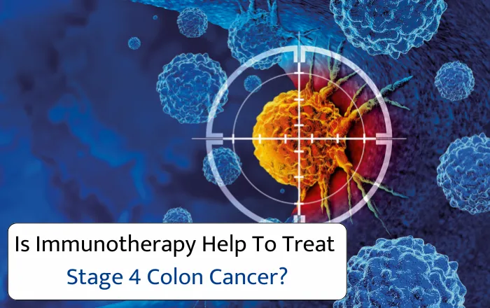 Is Immunotherapy Help To Treat Stage 4 Colon Cancer
