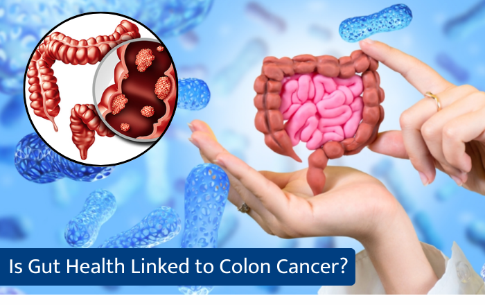 Is Gut Health Linked to Colon Cancer?