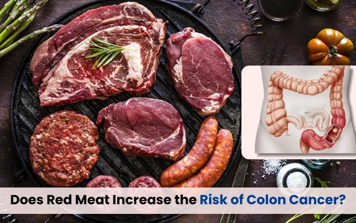 Does Red Meat Really Increase the Risk of Colon Cancer 1