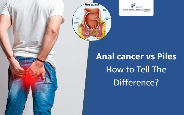 Anal cancer vs piles – how to tell the difference