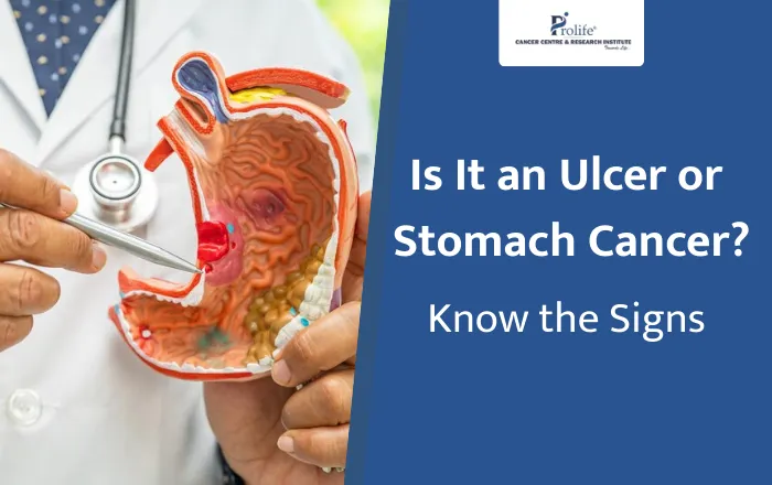 Is It an Ulcer or Stomach Cancer How to Tell the Difference