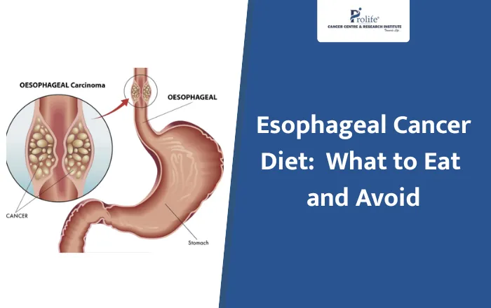 Esophageal Cancer Diet Foods to Eat and Avoid During Treatment